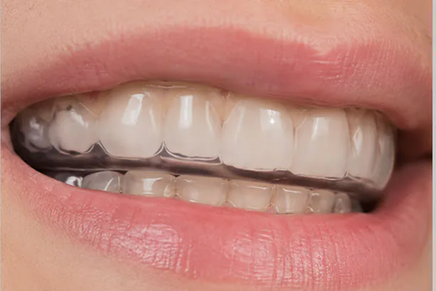 Bruxism mouth guard in mouth